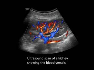 Kidney Ultrasound