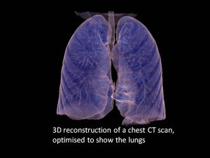 Chest CT scan