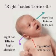 a baby with "right-sided torticollis," a condition where there is a noticeable tilt of the head. Specifically, the baby's right ear tilts toward the right shoulder, while the nose and face rotate to the left. This is due to tightness in the right sternocleidomastoid (SCM) muscle, which is marked in the image.