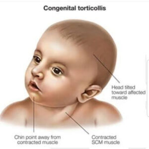 illustration labeled "Congenital Torticollis." It depicts a baby with a tilted head position, which is characteristic of this condition. The following features are marked: 1. Head tilted toward the affected muscle - The baby's head leans to one side, indicating the muscle contraction on that side. 2. Chin points away from contracted muscle - The baby's chin is turned away from the side with the contracted muscle. 3. Contracted SCM muscle - The Sternocleidomastoid (SCM) muscle on one side of the neck is shown as contracted, causing the tilt and turn of the head.