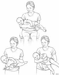 3 carrying positions designed to help manage torticollis in infants. These positions are likely intended to encourage the baby to stretch and strengthen the muscles on the side of the neck that are affected by torticollis. Here is a description of each position: 1. Top Position: The caregiver holds the baby horizontally across their lap, facing upward. This position helps support the baby’s body while allowing gentle stretching of the neck muscles. It encourages the baby to turn their head to the side, counteracting the head tilt. 2. Bottom Left Position: The baby is held in a sidelying position. The caregiver holds the baby in a way that promotes the stretching of the tight neck muscles by positioning the head to turn toward the side that is less used. This position can help reduce the tightness of the sternocleidomastoid muscle. 3. Bottom Right Position: The baby is carried in a more upright, side-lying position, but still encourages a turn of the head to the side opposite of the torticollis. This hold can be used during everyday activities to consistently promote head-turning to the non-preferred side.