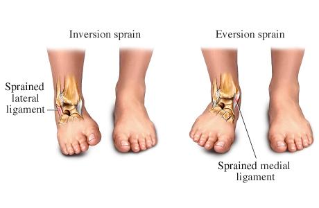 Illustration showing two types of ankle sprains: inversion sprain on the left with a sprained lateral ligament and eversion sprain on the right with a sprained medial ligament. Both images depict the position of the foot and the affected ligaments in the ankle.