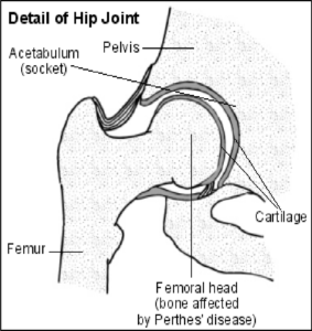 Detailed illustration of the hip joint showing key components including the acetabulum (hip socket), pelvis, femur (thigh bone), cartilage, and the femoral head. The femoral head is affected by Perthes disease