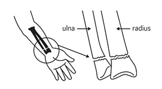 Diagram showing the bones of the forearm, labeled ulna and radius. In a wrist fracture, one or both of these bones may be broken