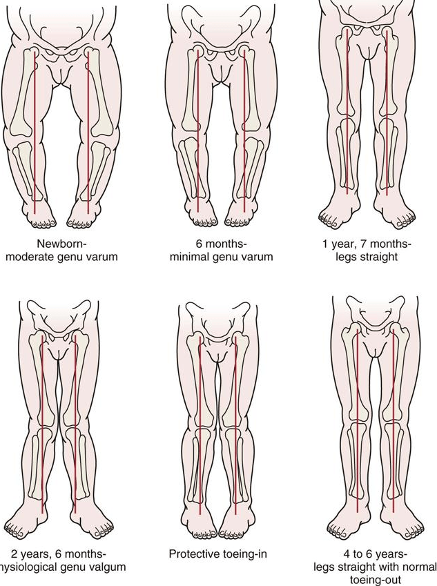 The diagram illustrates the progression of genu varum (bow legs) and genu valgum (knock knees) based on a child’s age:
At birth, newborns typically exhibit moderate genu varum (bow legs).
By 6 months, the bowing decreases and becomes minimal.
By the age of 1 year and 7 months, the legs usually straighten, showing no bowing.
At the bottom of the diagram, it shows the progression of genu valgum (knock knees) in three stages:
At around 2 years and 6 months, children develop physiological genu valgum (knock knees), often accompanied by protective toeing-in.
Between the ages of 4 to 6 years, the legs straighten naturally, with a normal toeing-out.