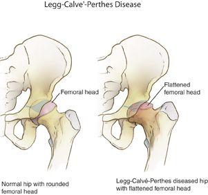 Illustration comparing a normal hip joint with a hip affected by Legg-Calvé-Perthes disease. The normal hip shows a smooth, round femoral head fitting perfectly into the acetabulum, while the hip with Perthes disease shows a flattened and irregular femoral head, indicating bone damage.