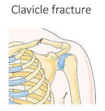 Anatomical drawing of a broken collarbone