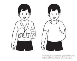 Illustration of a child with a cast immobilized arm in a cast. The child on the left is shown with a bandaged arm in a sling.. The child on the right is wearing a t-shirt over the sling,.