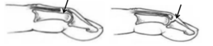 Two side-view anatomical illustrations of a finger with arrows pointing to the joint area. The first illustration shows a bent finger with the arrow highlighting the injured area, a tear of the the extensor tendon. The second illustration shows the finger in an extended position, with the arrow pointing to a broken bone in the finger tip.